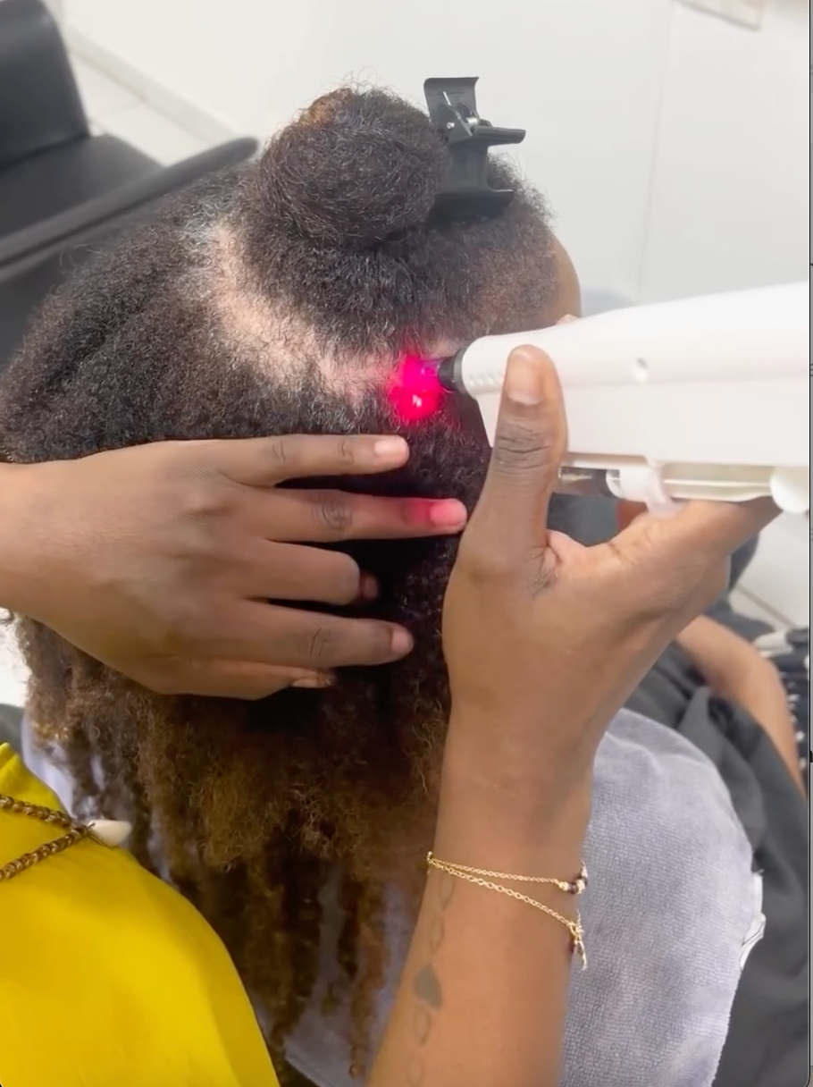 Hairneedling: demi-tête