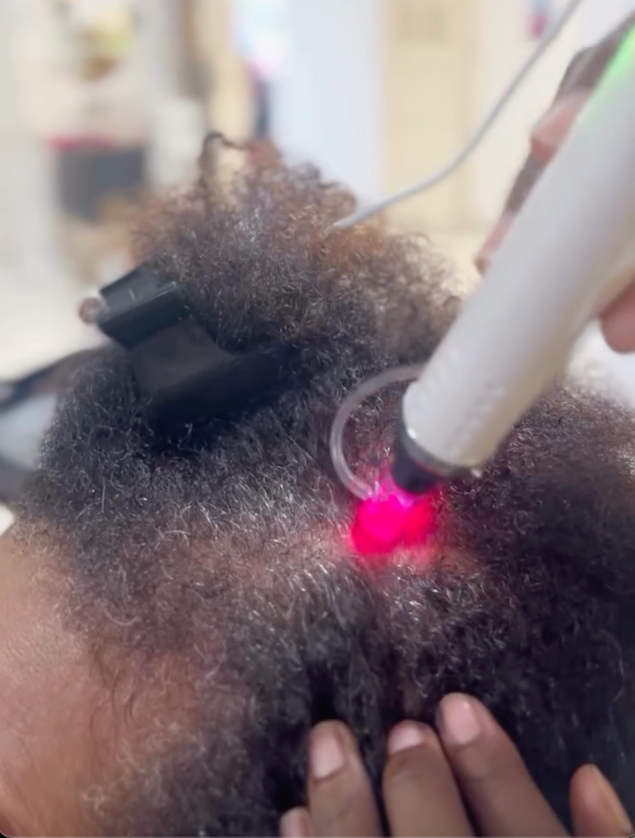 Hairneedling: tempes ou petites zones